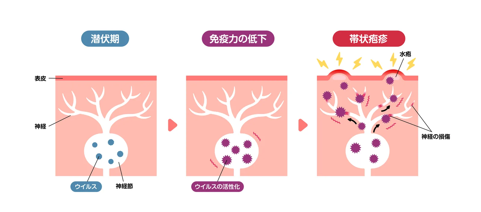 帯状疱疹の発症の仕組みを示す図