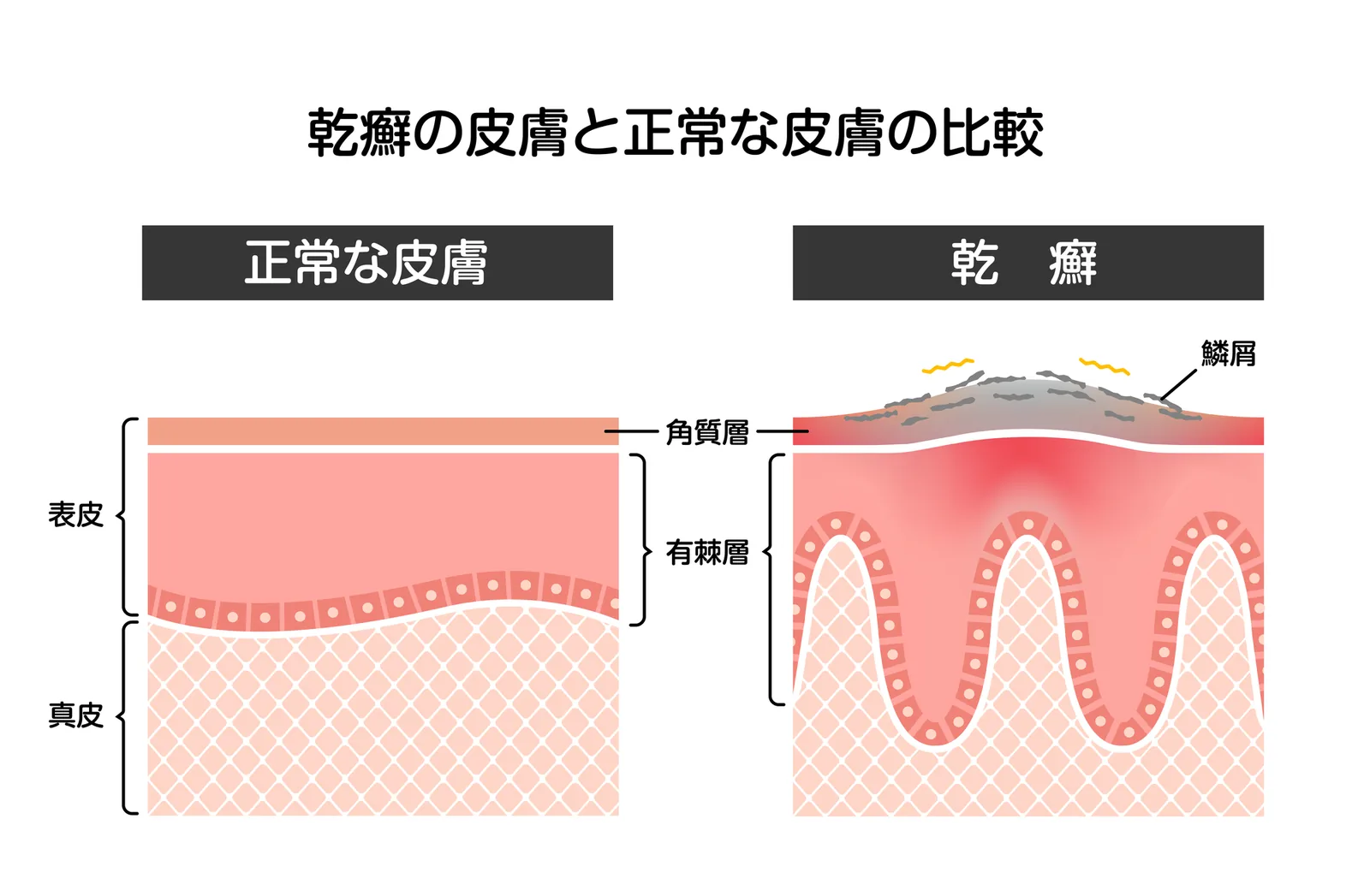 乾癬の好発部位のイメージ